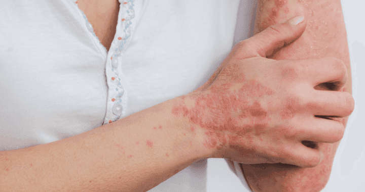 Managing chronic inflammation with psoriasis